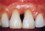 Parodontoza je bolest koja oduzima osmijeh