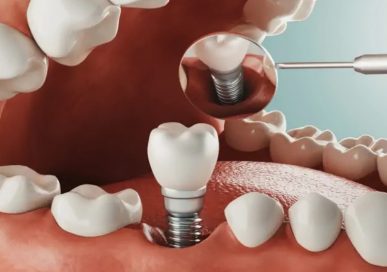 Zubni Implantati