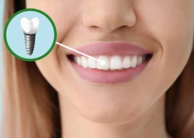 Zubni implantati pomažu pacijentima u vraćanju funkcionalnosti usnoj šupljini.