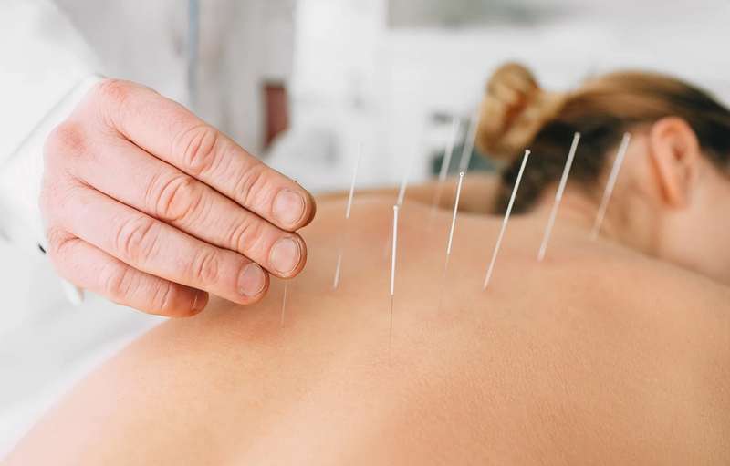 koristi akupunkture